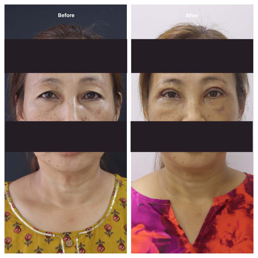 Eyelid Surgery KOQ10